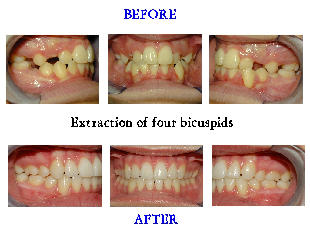 Extraction of 4 bicuspids