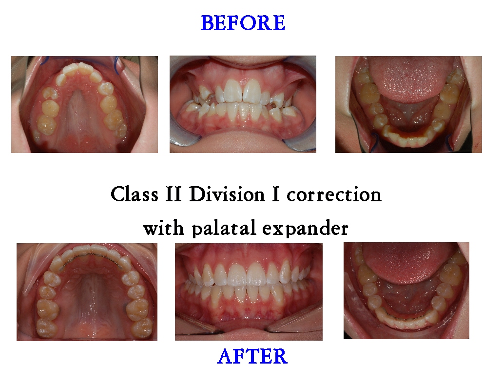 Class 2 Division 1 Correction with an RPE
