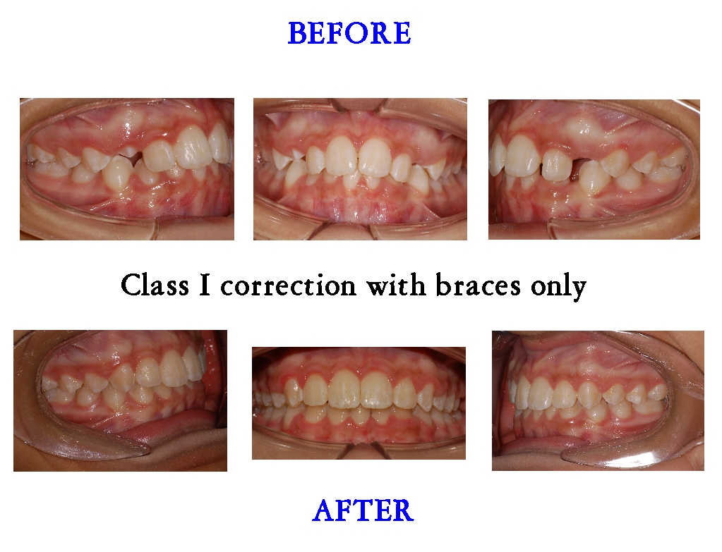 Class 1 Braces Only