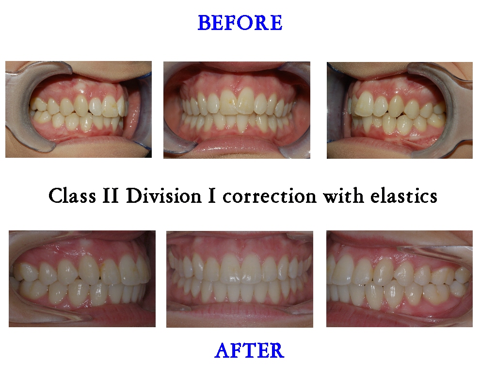 Class 2 Division 2 Braces Only