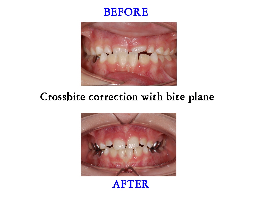 Crossbite correction with a bite plane